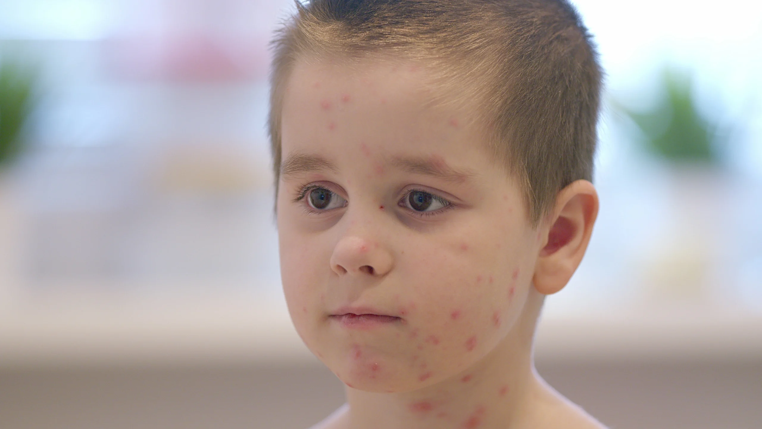 Mehr Windpockenfälle in Bochum: Ärzte raten zur Impfung